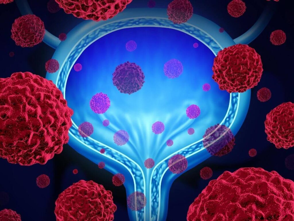 São Paulo tem campanha para prevenção do câncer de bexiga