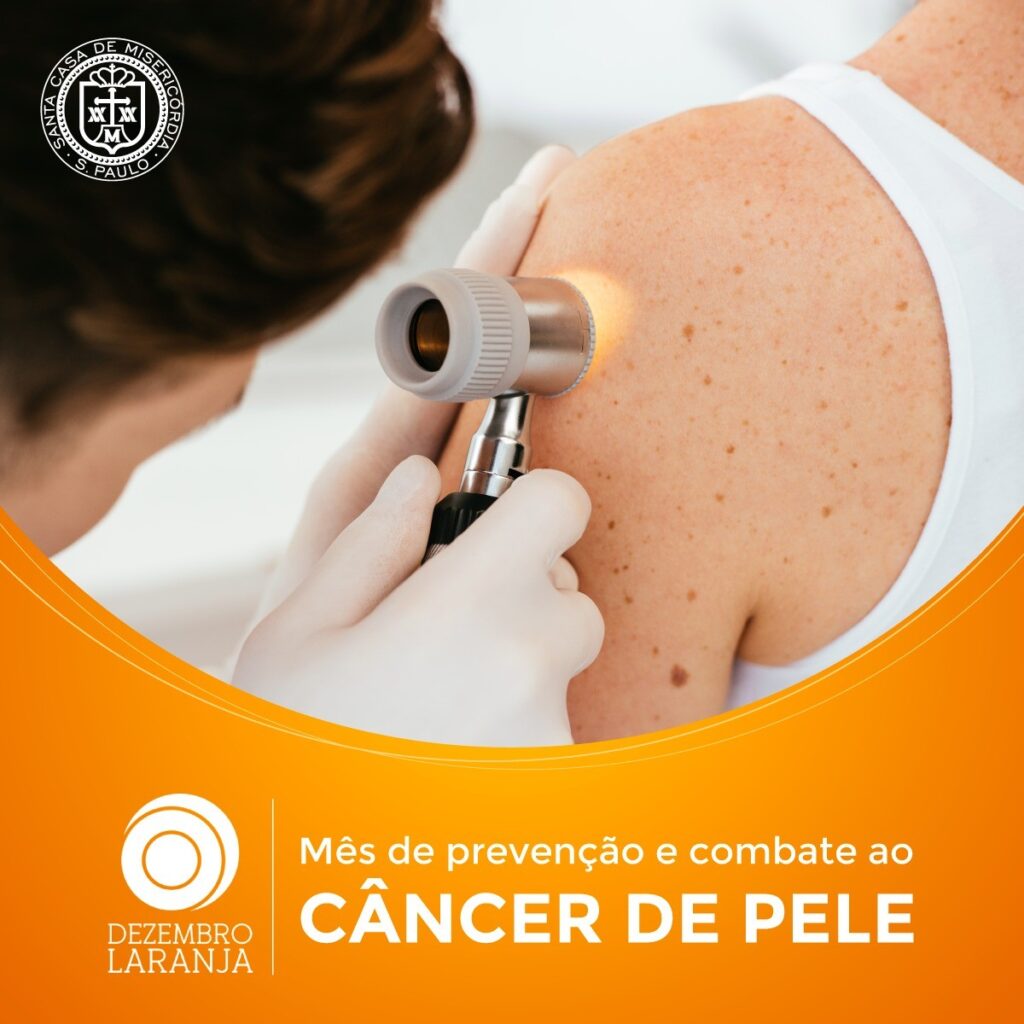 Santa Casa faz dia de orientação contra o câncer de pele - Jornal O São Paulo
