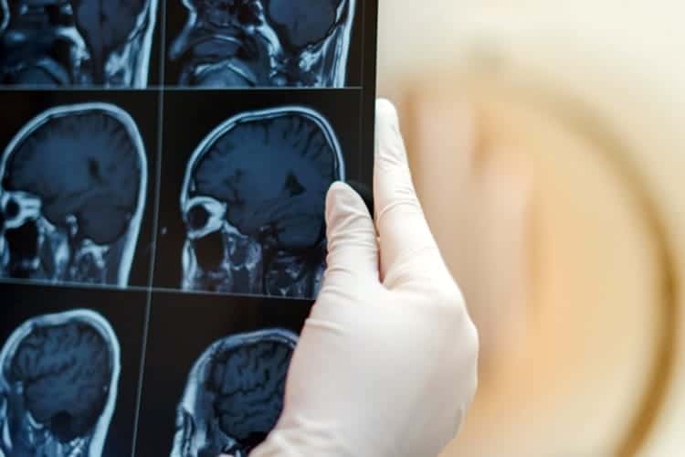 Acidente Vascular Cerebral (AVC) atinge 13,7 milhões de pessoas no mundo, segundo OMS - Jornal O São Paulo