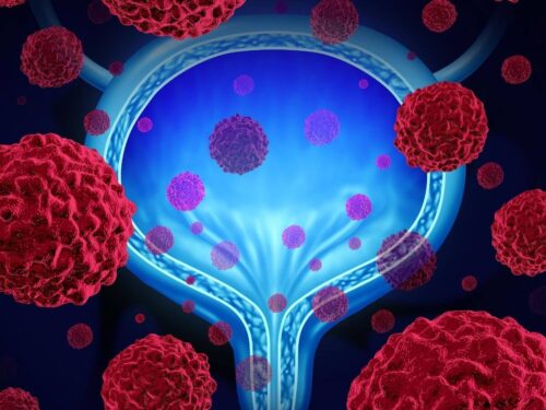 São Paulo tem campanha para prevenção do câncer de bexiga