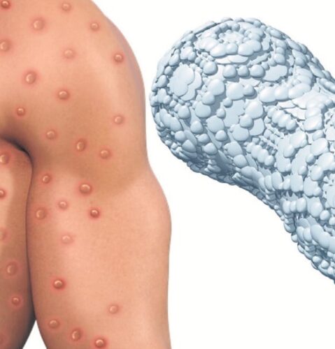 O que já se sabe sobre a nova varíola e como é possível se proteger? - Jornal O São Paulo