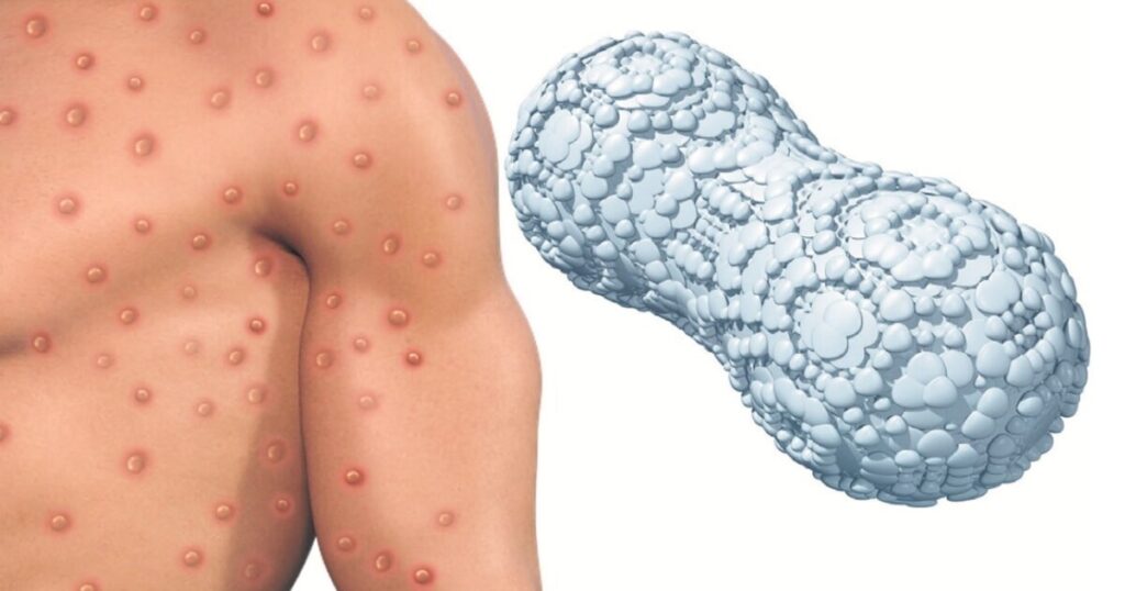 O que já se sabe sobre a nova varíola e como é possível se proteger? - Jornal O São Paulo