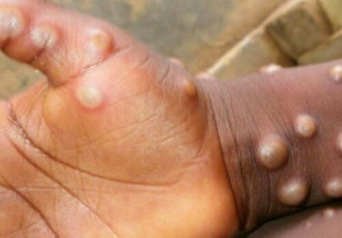 São Paulo lança plano de enfrentamento à varíola dos macacos