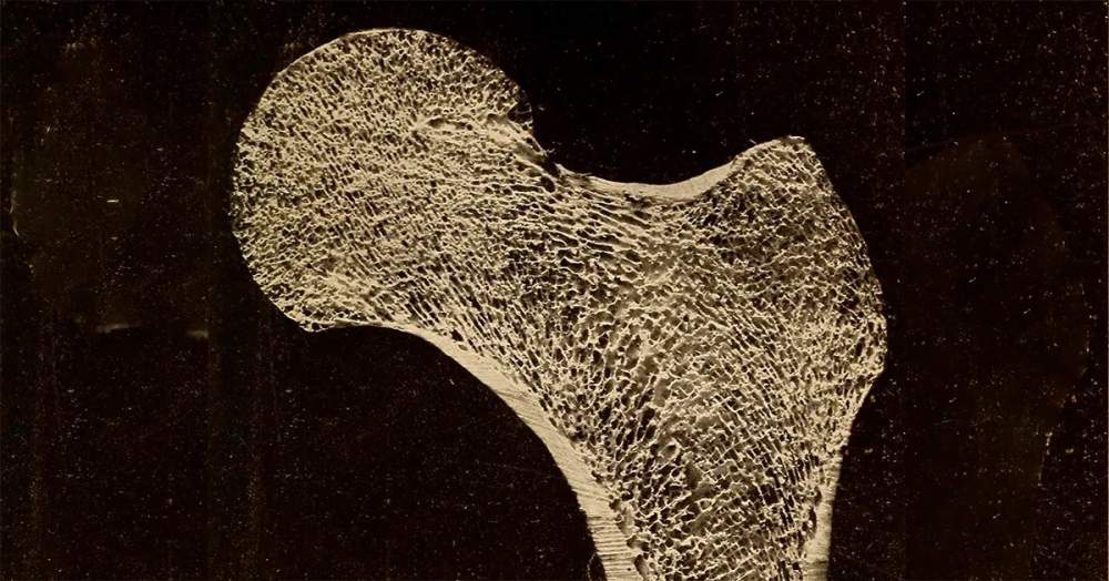 Novo tratamento para osteoporose pode aumentar massa óssea em até 20% - Jornal O São Paulo