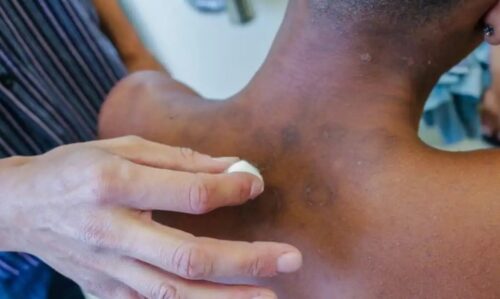 Novos casos de hanseníase aumentaram 5% de janeiro a novembro de 2023 - Jornal O São Paulo